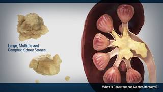 Percutaneous Nephrolithotomy PCNL [upl. by Attwood830]