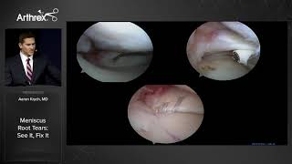 Arthroscopic Knee Surgery  Meniscus Surgery Performed by Dr Millstein [upl. by Niamert449]