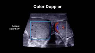 Diagnosing testicular torsion [upl. by Ettesyl850]