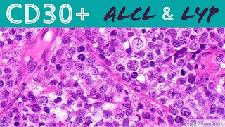 Anaplastic Large Cell Lymphoma amp Lymphomatoid Papulosis CD30 Positive Lymphoproliferative Disorders [upl. by Atiuqan]