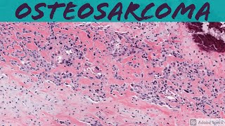 Osteosarcoma 101 Bone Pathology Basics [upl. by Killam]