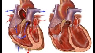 Congestive Heart Failure [upl. by Adnav90]