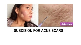 Acne scar treatment Subcision and TCA cross [upl. by Norrad]