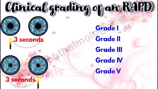 Pupil 4  Clinical grading of an RAPD  Marcus Gunn Pupil [upl. by Sulakcin970]