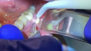 Draining a Dental Abscess  Advanced Dental Care [upl. by Acus]