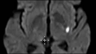 Swallowing and Communication after Stroke [upl. by Yecal]