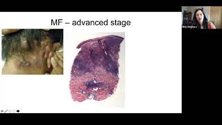 Pathology Grand Rounds  Cutaneous TCell Lymphoma  Dr Michi Shinohara [upl. by Schrader]