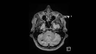 Physical Examination of Arteriovenous Fistula [upl. by Nairbo]