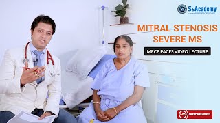 MRCP PACES Clinical Case  Cardiology  Severe Mitral Stenosis MS [upl. by Kirstin]