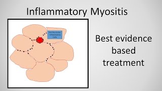 Myositis Inflammatory Myopathy Treatment [upl. by Noicpesnoc]