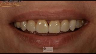 Laminate veneers from preparation to cementation [upl. by Gahan]