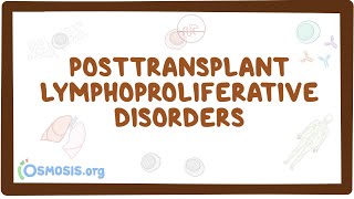 Posttransplant lymphoproliferative disorders  causes symptoms diagnosis treatment pathology [upl. by Boone86]