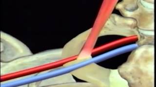 Tunneled Hickman Catheter Insertion BARD [upl. by Deden]