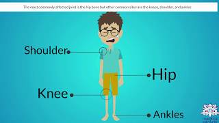 OSTEONECROSIS Causes Signs and Symptoms Diagnosis and Treatment [upl. by Orth]