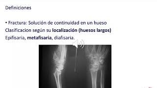 GENERALIDADES DE ORTOPEDIA Y TRAUMATOLOGIA [upl. by Notsniw]