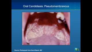 Oral Manifestations of HIV Case Studies [upl. by Melly885]