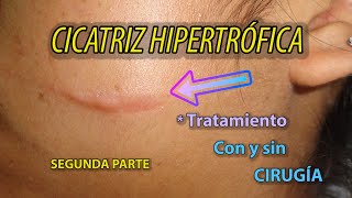 💥 CICATRIZ Hipertrófica  Cómo se trata PARTE 2 FINAL [upl. by Marthe]