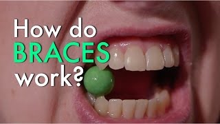 How Do Braces Work [upl. by Sandi]