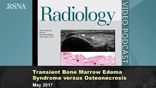 Transient Bone Marrow Edema Syndrome versus Osteonecrosis May 2017 Radiology [upl. by Ahsets130]