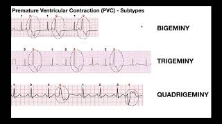 EKG Patterns  Premature Atrial amp Ventricular Contractions PACs amp PVCs [upl. by Akerue]