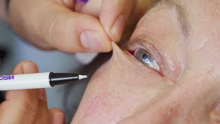 Artificial eye removal with suction cup [upl. by Schalles]