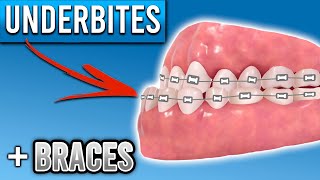 How Do Braces Fix Underbites  Premier Orthodontics [upl. by Anawot]