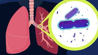 What is NTM Lung Disease [upl. by Nauaj]