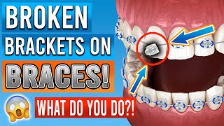 Broken Braces Brackets What You Need To Know [upl. by Enrobyalc]