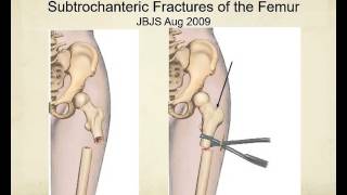 Proximal femur fractures how to identify and avoid malreduction malrotation [upl. by Atselec764]