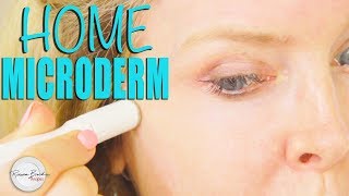 How to do Microdermabrasion at Home DIY [upl. by Aicilanna]