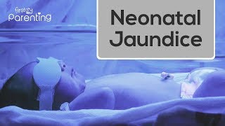 Neonatal Jaundice  Causes Symptoms and Treatment [upl. by Llenil]