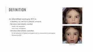 Intermittent Exotropia Characteristics [upl. by Halonna19]