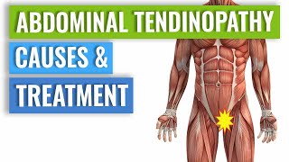 Abdominal Tendinopathy  Causes and Treatment Including Exercises [upl. by Einitsed]