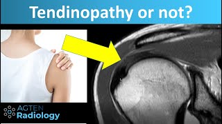 Tendinopathy Tendinosis of Rotator Cuff Tendons on MRI [upl. by Wye]