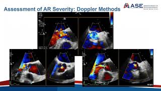 Joint Echo Conference Aortic Insufficiency [upl. by Debo]