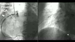 Coronary CT Angiography Cath [upl. by Draned]