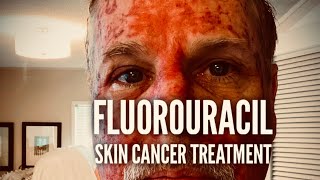 Fluorouracil Skin Treatment  Before During and After [upl. by Kcirdneked]