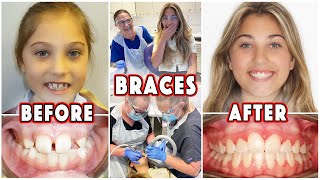 Getting BRACES Before And After  Rosie McClelland [upl. by Mara]