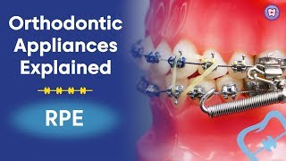 Orthodontic Appliances Explained  RPE [upl. by Tebazile]