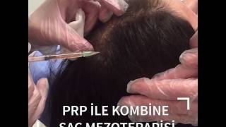 PRP İLE KOMBİNE SAÇ MEZOTERAPİSİ [upl. by Anaidni]