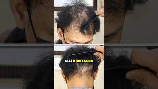 Alopecia Areata [upl. by Indnahc]