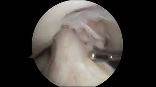 Torn Meniscus Arthroscopic Surgery [upl. by Rothberg78]