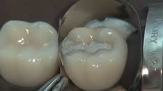 Class II Amalgam Preparation amp Restoration  Operative Dentistry [upl. by Yenttihw]