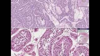 Histopathology TestisEndodermal sinus tumor yolk sac tumo [upl. by Gothurd]