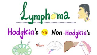 Hodgkin’s Lymphoma vs NonHodgkins Lymphoma  Comparison  Hematology and Oncology [upl. by Aihsekan]