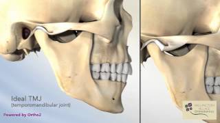 Locking of the Jaw and How to Unlock [upl. by Artinahs]