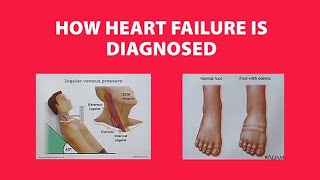 How Heart Failure is Diagnosed [upl. by Berman592]