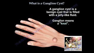 What Is A Ganglion Cyst  Everything You Need To Know  Dr Nabil Ebraheim [upl. by Arnst]