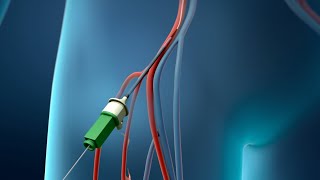 Coronary Angioplasty Femoral Access [upl. by Adnaugal]