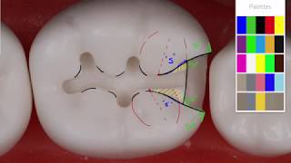 Class II Amalgam 19 MO Acadental  Amalgam Preparation Technique [upl. by Eelrefinnej199]